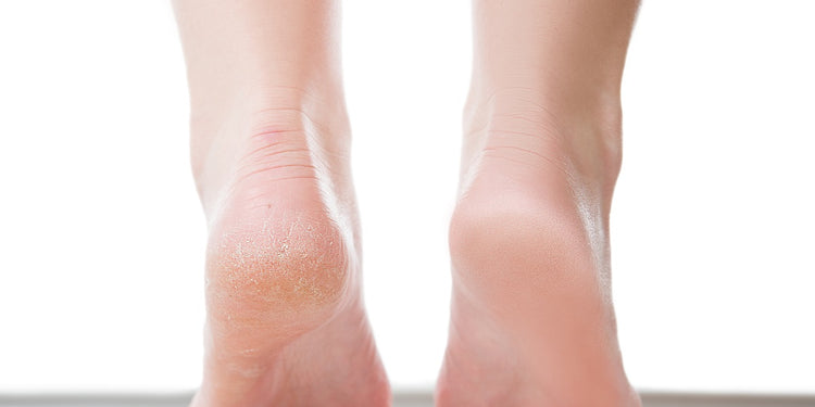 What causes cracked heels? - Ace Health Centre
